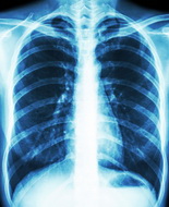 Fibrosi polmonare idiopatica grave, Sildenafil come potenziale aiuto per la funzionalità polmonare